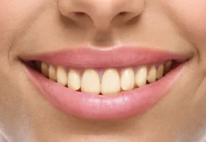 Imagem de sorriso antes do branqueamento dentário