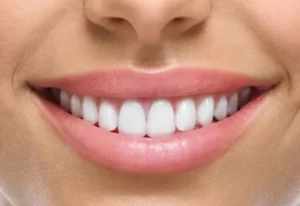 Imagem de sorriso depois do branqueamento dentário