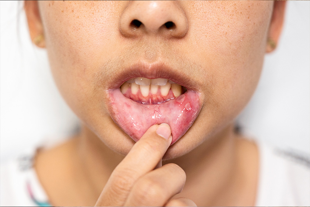 Menina a sorrir com os dentes tortos sem aparelho dentário Mulher com aftas nos lábios