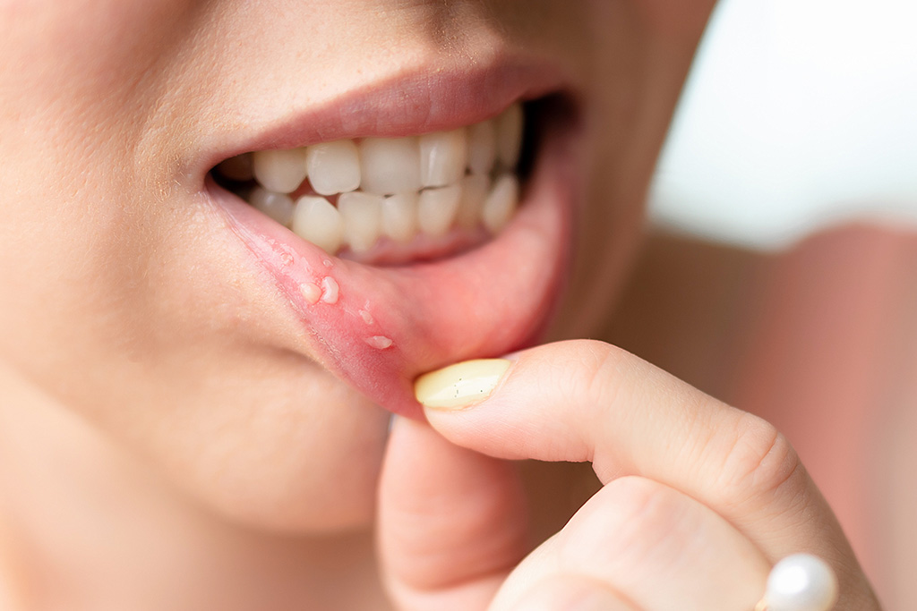Lábios com aftas que precisam ser tratadas