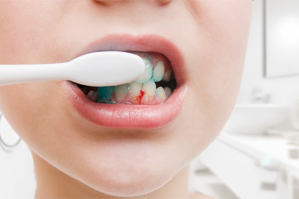 Menina a sorrir com os dentes tortos sem aparelho dentário Criança com sangramento ao escovar
