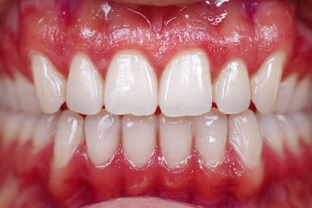 Sorriso após tratamento de ortodontia